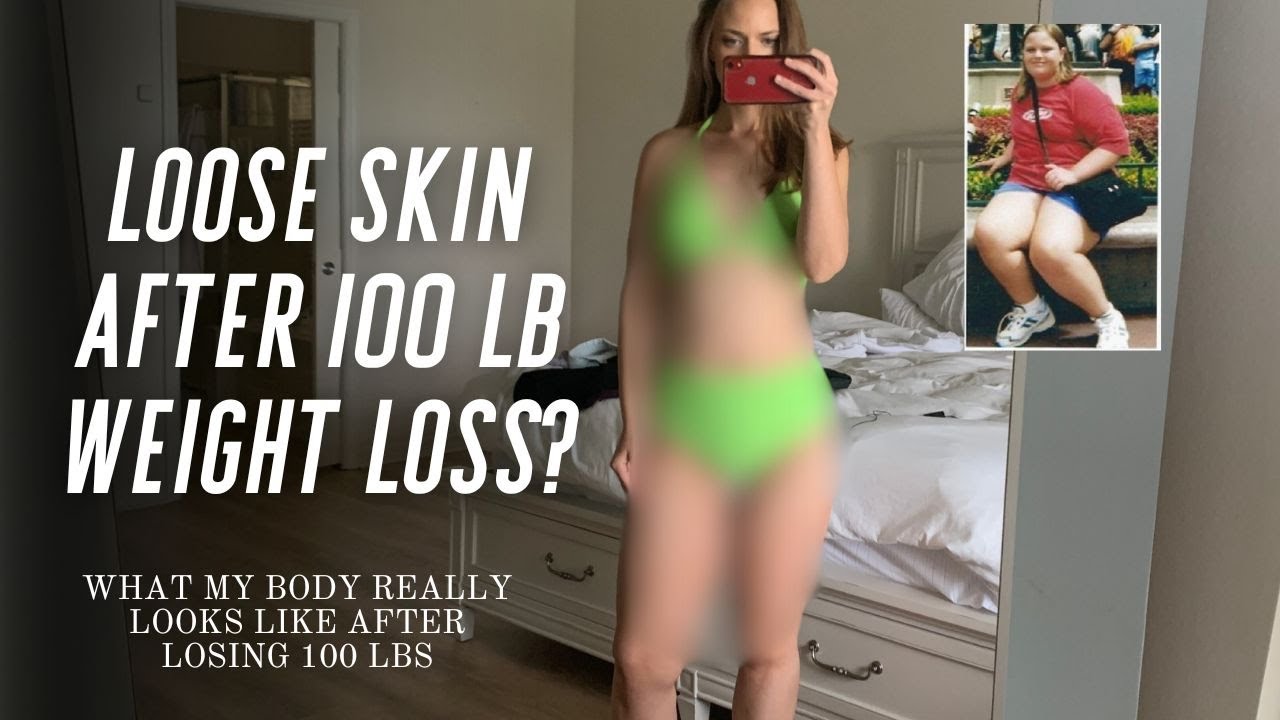 Loose skin after losing 100 pounds Whitney Holcombe